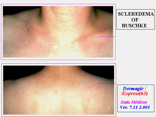 Escleredema de Buschke, cuello y hombros.
