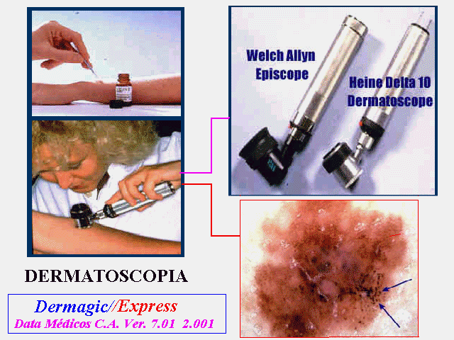 The Dermatoscope, to view skin lesions with a magnifying lens El Dermatoscopio, para ver lesiones de piel con lentes de aumento
