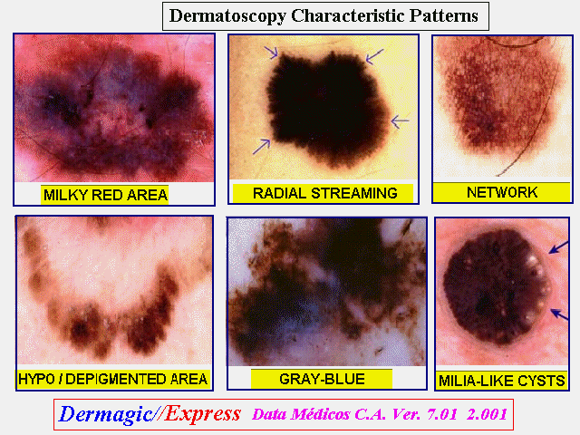 Skin patterns (I) seen with the Dermatoscope Patrones de piel (I) vistos con el Dermatoscopio