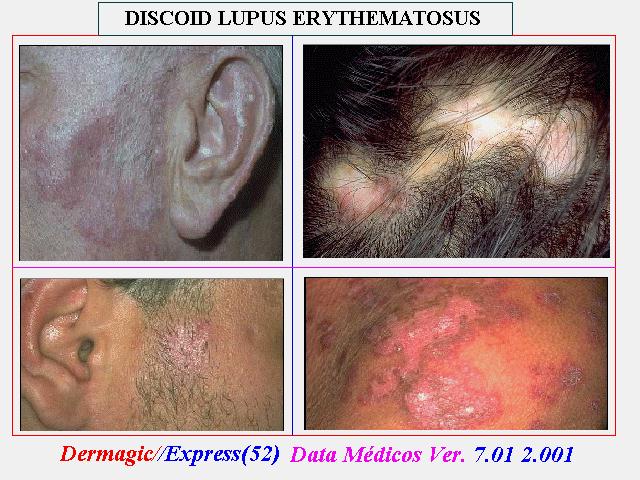Lupus eritematoso discoide: cara, orejas, hombros y cuero cabelludo.