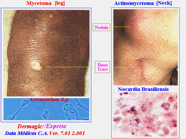 Micetoma de la pierna (Acremonium) y actinomicetoma de la región facial (cuello) (Nocardia).