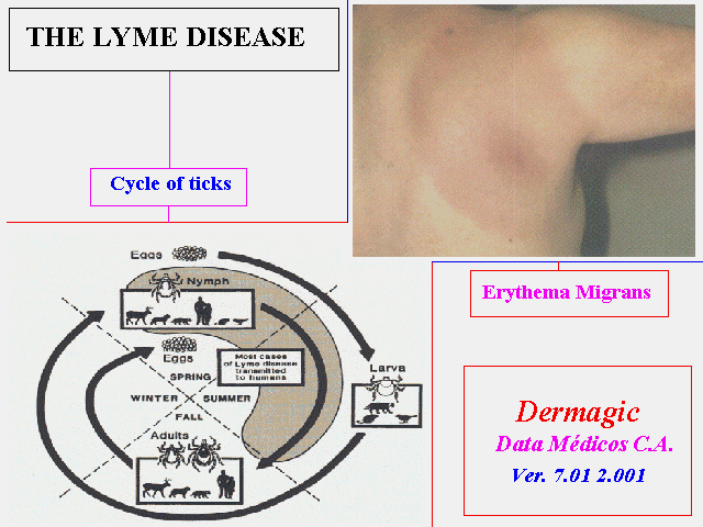Emfermedd de Lyme o Eritema Cronico migrans, lesion en ojo de buey