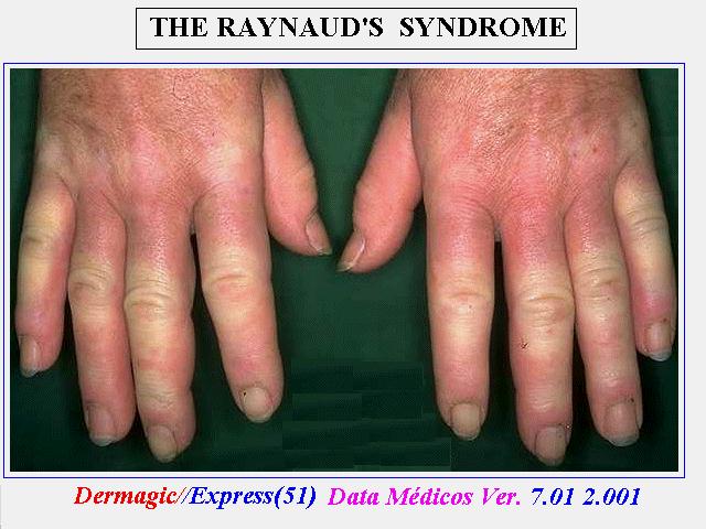 El Síndrome de Raynaud