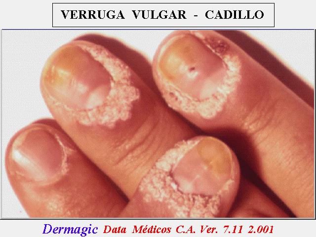 Verruga Vulgar Periungueal