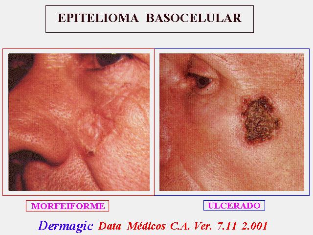  Epiteloma baso celular morfeiforme y ulcerado