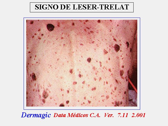 El signo de LESSER TRELAT, y su asociación con malignidad