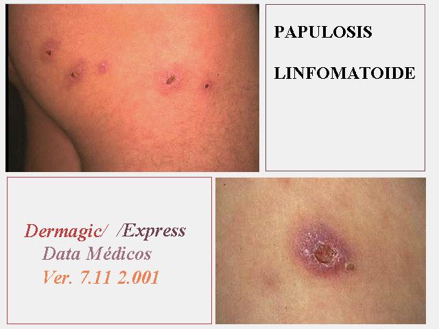 Lymphomatoid Papulosis Papulosis Linfomatoide