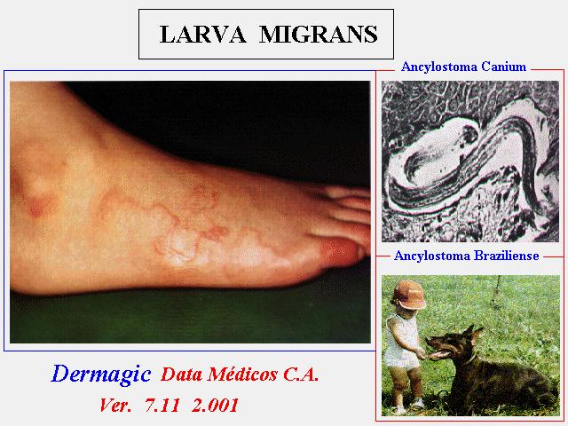 El síndrome d Larva Migrans cutanea