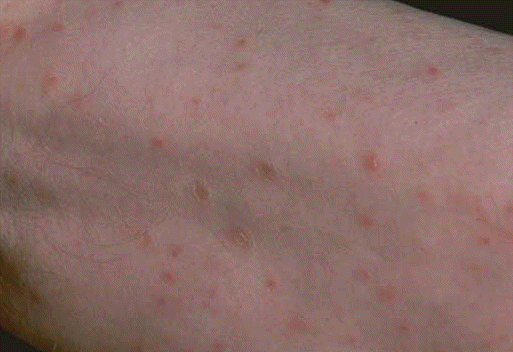 Pitiriasis Liquenoide Cronica