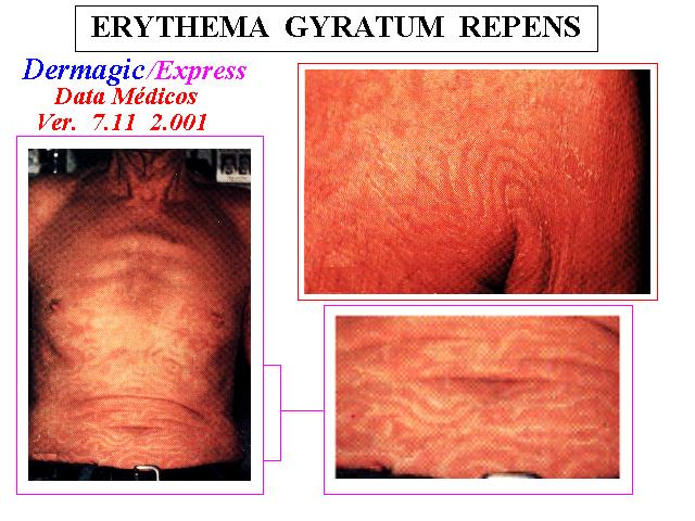 
 EL Eritema Gyratum repens y asociación con malignidad