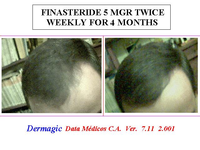 Finasteride 5 Mgr, Twice weekly for 4 months Finasteride 5 Mgr, 2 veces semanal por 4 meses