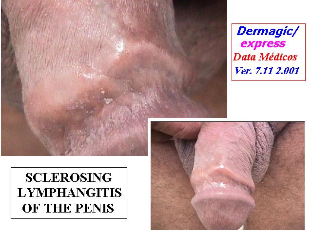  Linfangitis esclerosante del pene