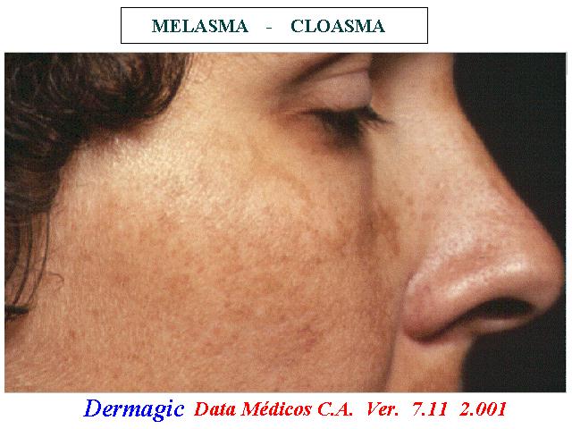 Cloasma Gravídico, hiperpigmentación por aumento de melanogenesis