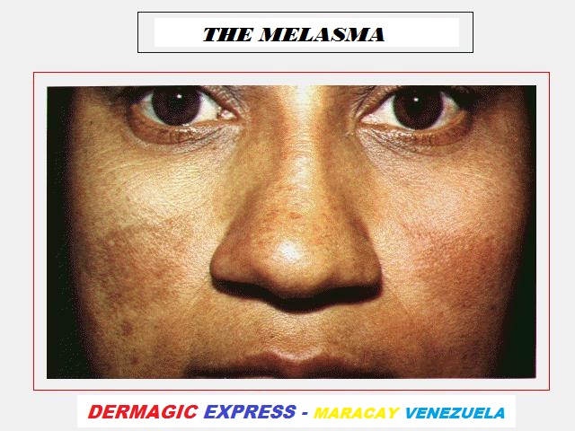 Melasma (hiperpigmentacion) facial, nariz, pomulos y supralabial