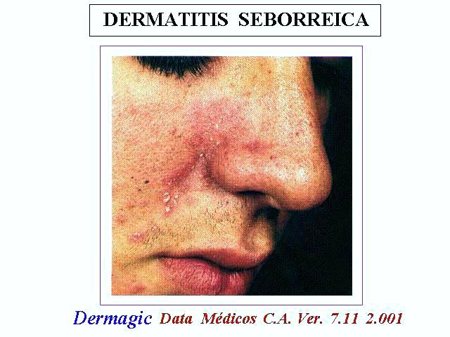 Seborrheic dermatitis, paranasal region of the face. Dermatitis seborreica, region paranasal de la cara.