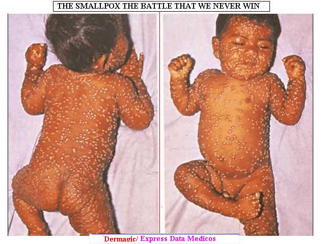  Niño recien nacido con Viruela