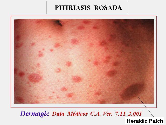 Classic Pityriasis Rosea, with Heraldic Plate on the abdomen