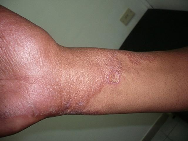 Indurated erythematous plaque on right forearm, BT leprosy, male, 23 years old paciente con lepra
