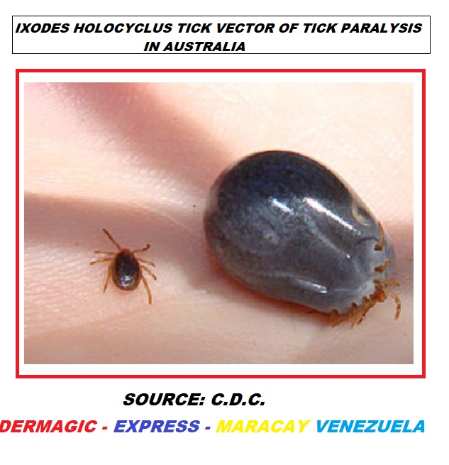 Tick Ixodes Holocyclus, Vector of Tick Parslysis in Australia.