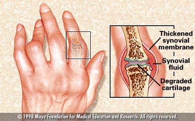 Artritis Reumatoide