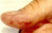 Lesiones de Janeway