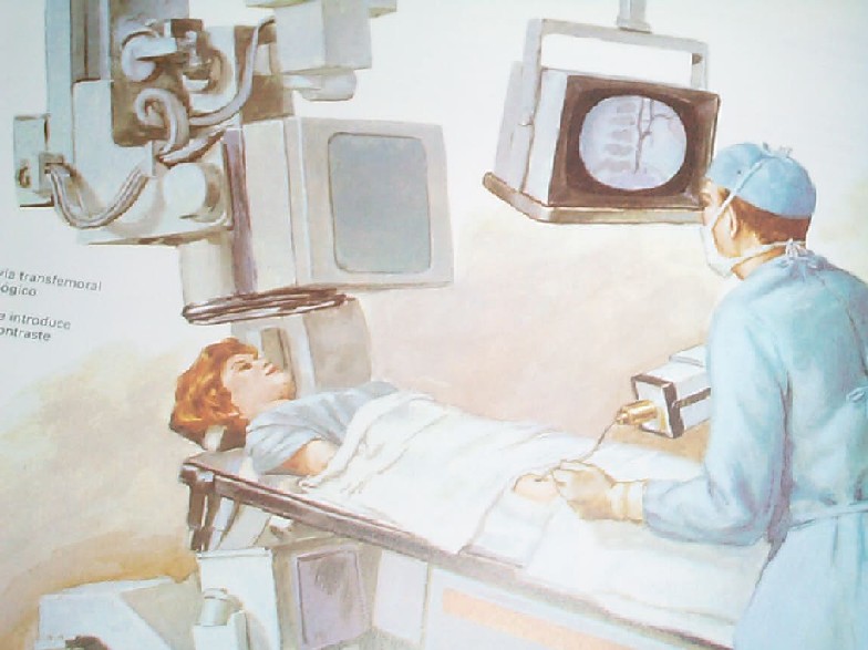 ANGIOGRAFIA