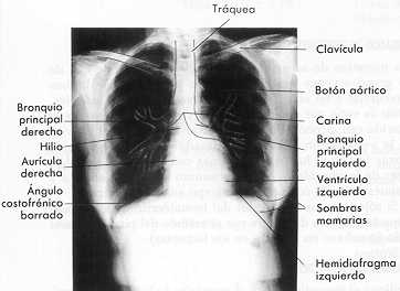 Rx A-P. de t�rax