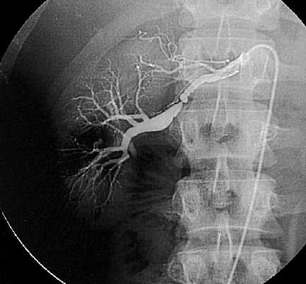 Estenosis arteria renal