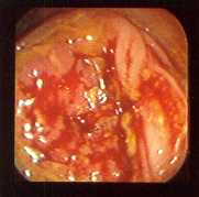 Adenocarcinoma
