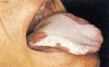 Candidiasis