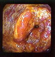 Carcinoma de ciego