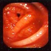 Colon transverso