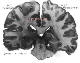 Corte coronal