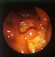 Enfermedad de Crohn