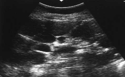 Ecografia renal