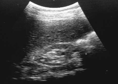 Insuficiencia renal cr�nica