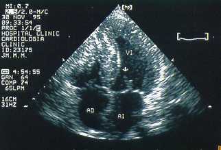 Miocardiopat�a hipertr�fica