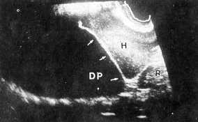 Derrame pleural