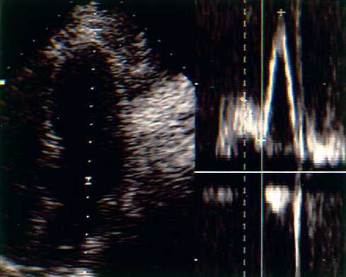 Cardiopat�a hipertensiva