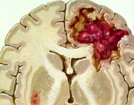 Cerebral infarction