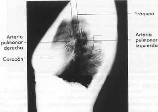 Rx lateral de t�rax