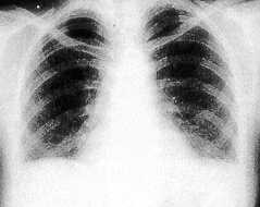 Lupus