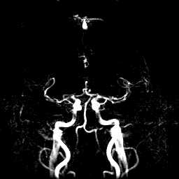 mri-angiograf�a