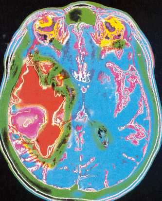 Tumor cerebral -24K