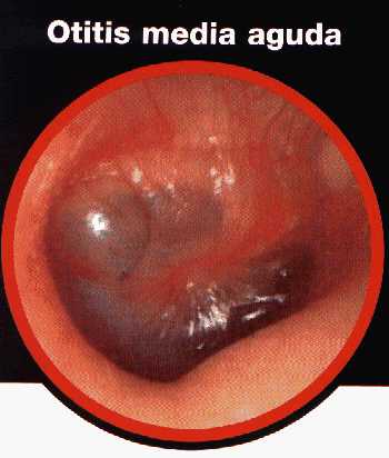 Otitis Media Aguda