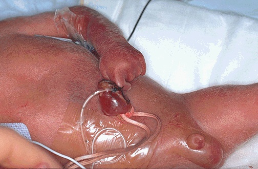 Onfalocele