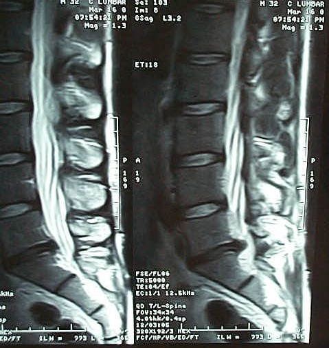 HERNIA DISCAL