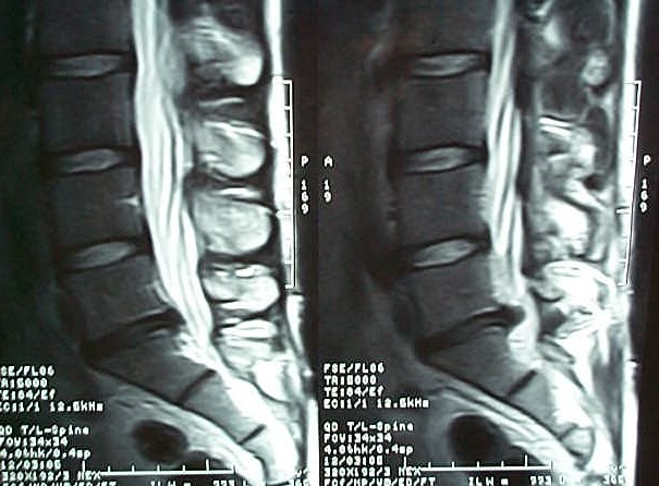 HERNIA DISCAL