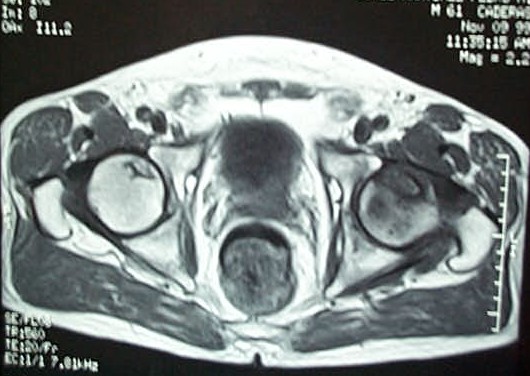 necrosis caderas