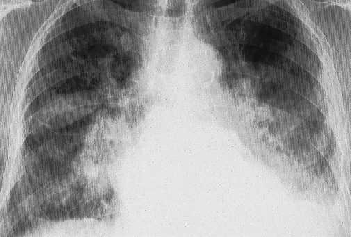 Hipertensi�n arterial